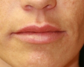Feel Beautiful - Lip Augmentation with Juvederm, San Diego - After Photo